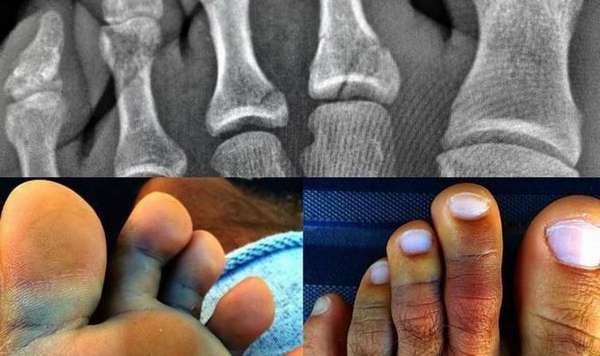 Рентгеновский снимок - основной метод диагностики перелома пальцев ноги